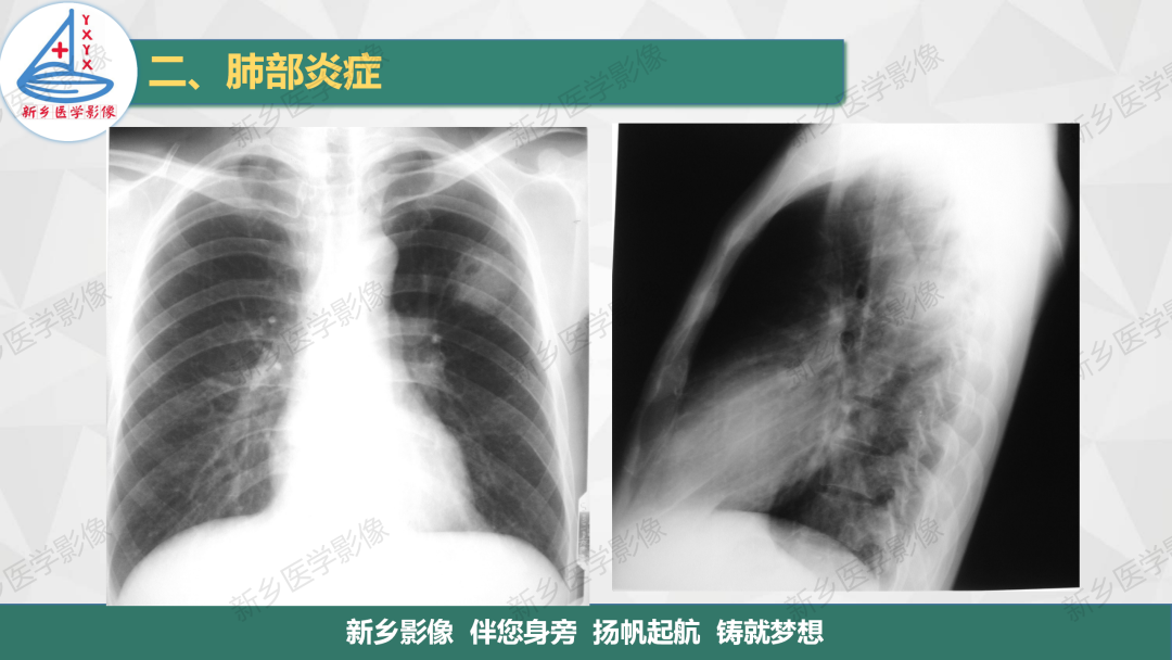 影像PPT - 【PPT】医学影像诊断学教材解读—肺部病变2-28