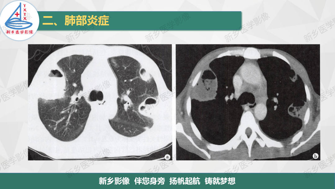 影像PPT - 【PPT】医学影像诊断学教材解读—肺部病变2-31