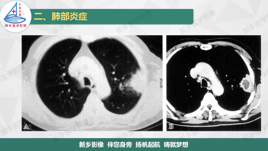 影像PPT - 【PPT】医学影像诊断学教材解读—肺部病变2-30