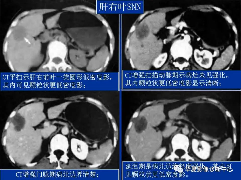 影像PPT - 【PPT】孤立性肝脏坏死结节的影像学表现-10
