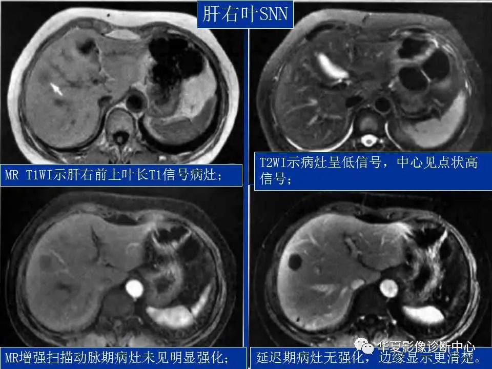 影像PPT - 【PPT】孤立性肝脏坏死结节的影像学表现-11