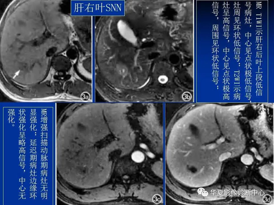 影像PPT - 【PPT】孤立性肝脏坏死结节的影像学表现-12