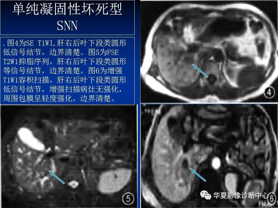 影像PPT - 【PPT】孤立性肝脏坏死结节的影像学表现-17