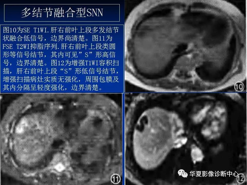 影像PPT - 【PPT】孤立性肝脏坏死结节的影像学表现-19