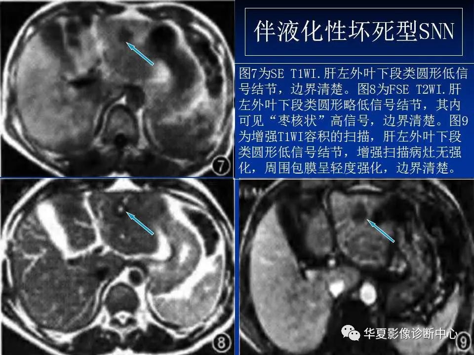 影像PPT - 【PPT】孤立性肝脏坏死结节的影像学表现-18