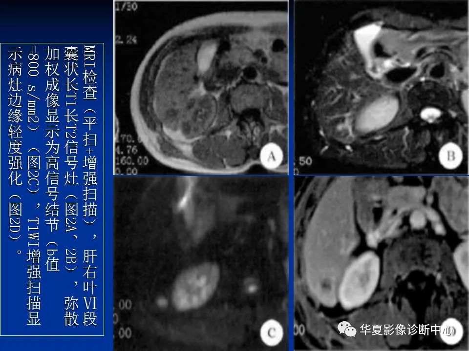 影像PPT - 【PPT】孤立性肝脏坏死结节的影像学表现-21