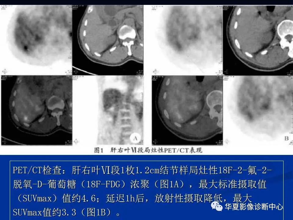 影像PPT - 【PPT】孤立性肝脏坏死结节的影像学表现-22