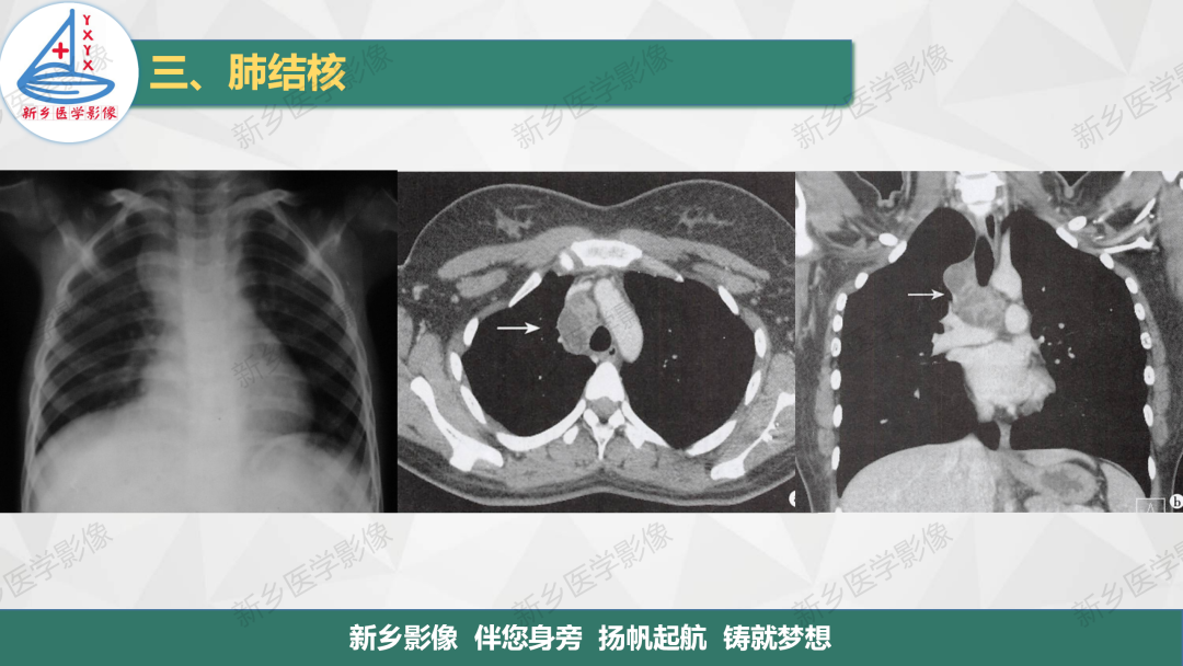 影像PPT - 【PPT】医学影像诊断学教材解读—肺部病变3-10