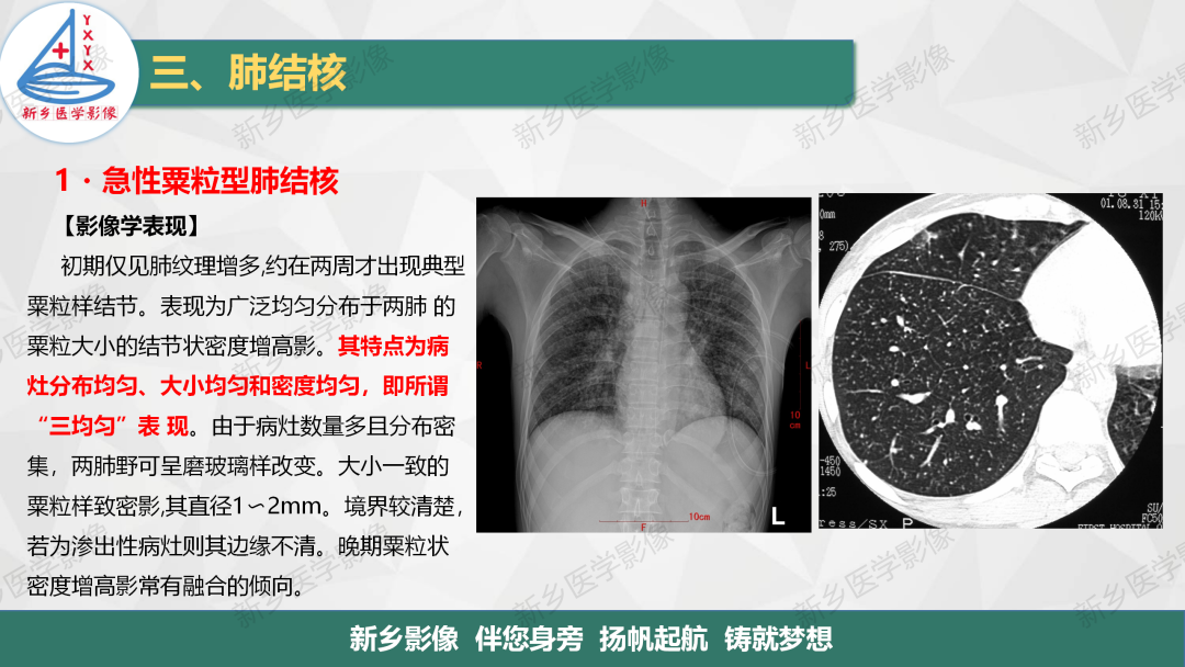 影像PPT - 【PPT】医学影像诊断学教材解读—肺部病变3-12