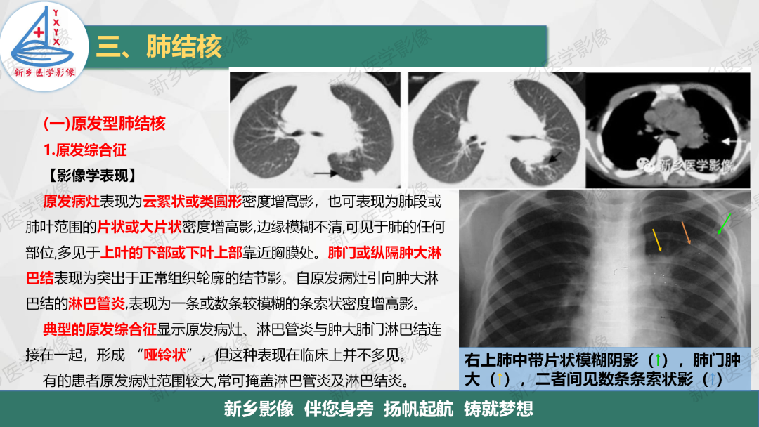 影像PPT - 【PPT】医学影像诊断学教材解读—肺部病变3-7
