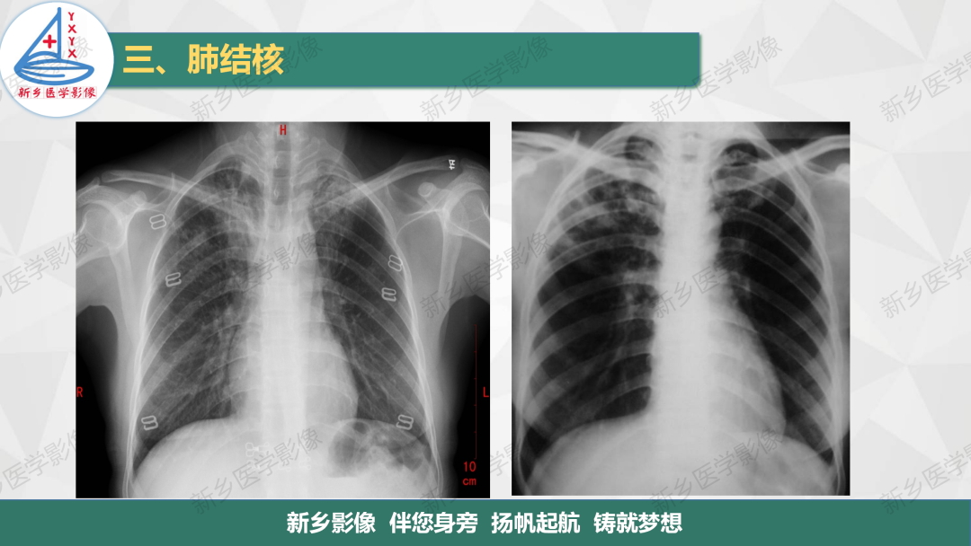 影像PPT - 【PPT】医学影像诊断学教材解读—肺部病变3-15