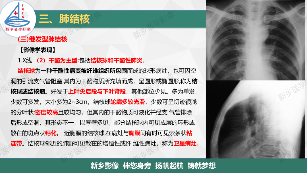 影像PPT - 【PPT】医学影像诊断学教材解读—肺部病变3-16