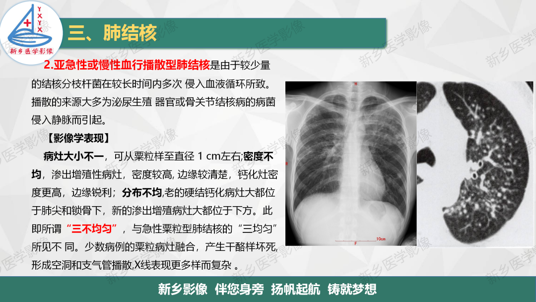 影像PPT - 【PPT】医学影像诊断学教材解读—肺部病变3-13