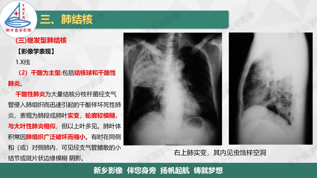 影像PPT - 【PPT】医学影像诊断学教材解读—肺部病变3-17