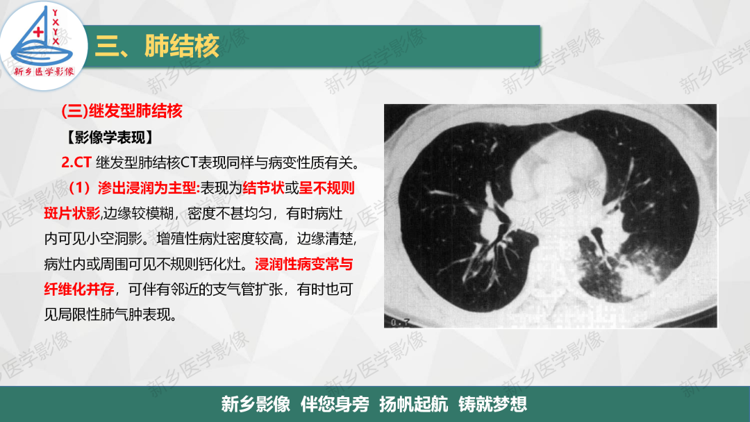 影像PPT - 【PPT】医学影像诊断学教材解读—肺部病变3-19