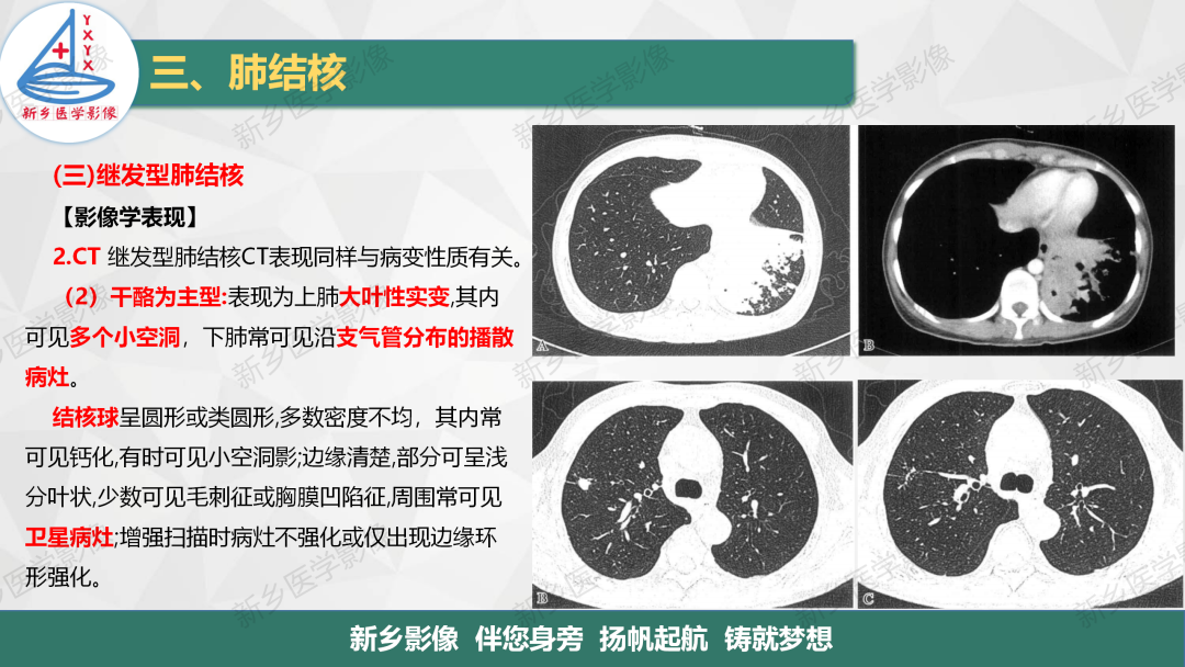 影像PPT - 【PPT】医学影像诊断学教材解读—肺部病变3-20