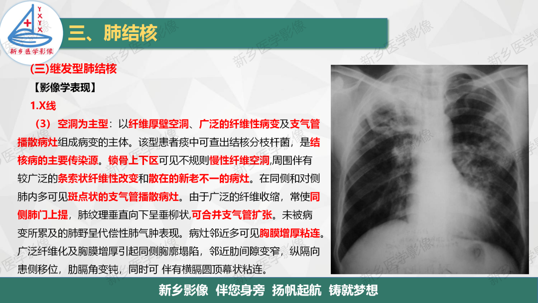 影像PPT - 【PPT】医学影像诊断学教材解读—肺部病变3-18