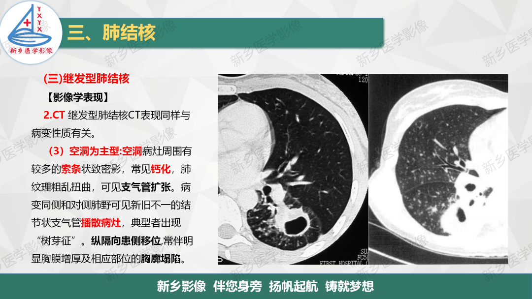 影像PPT - 【PPT】医学影像诊断学教材解读—肺部病变3-21