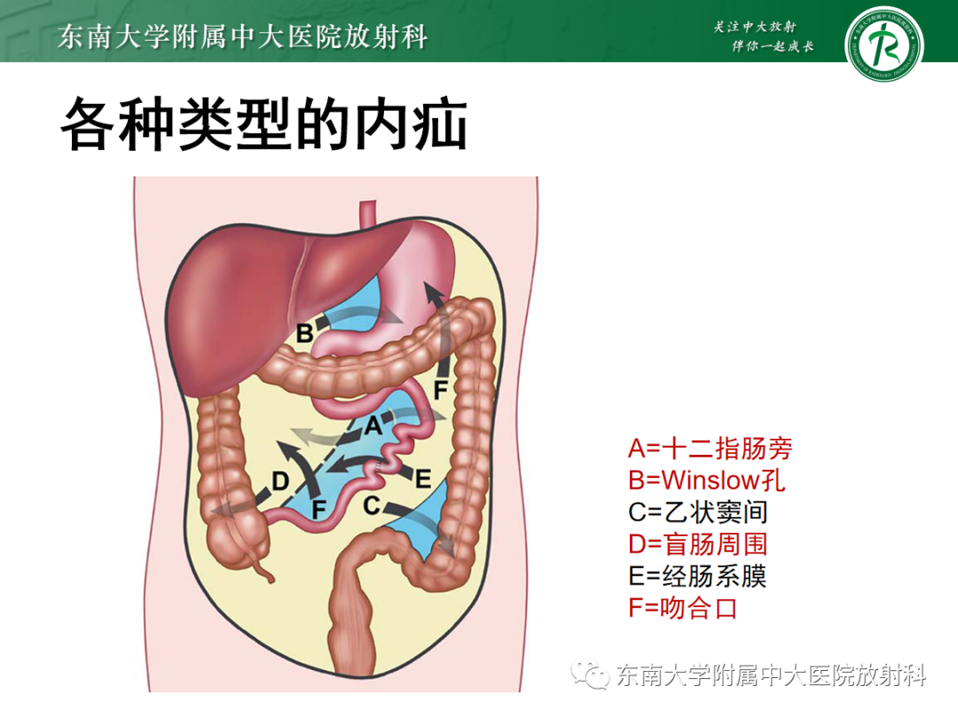 影像PPT - 【PPT】绞窄性小肠梗阻不可忽视的病因——腹内疝-6