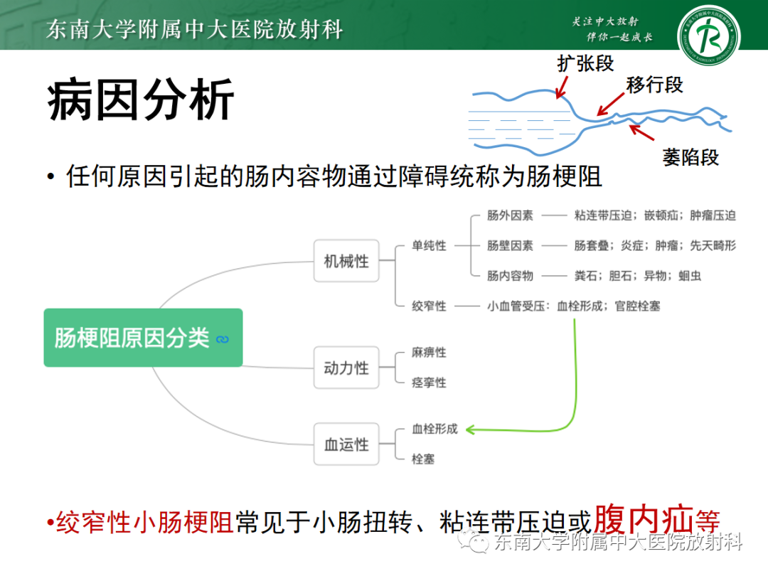影像PPT - 【PPT】绞窄性小肠梗阻不可忽视的病因——腹内疝-1