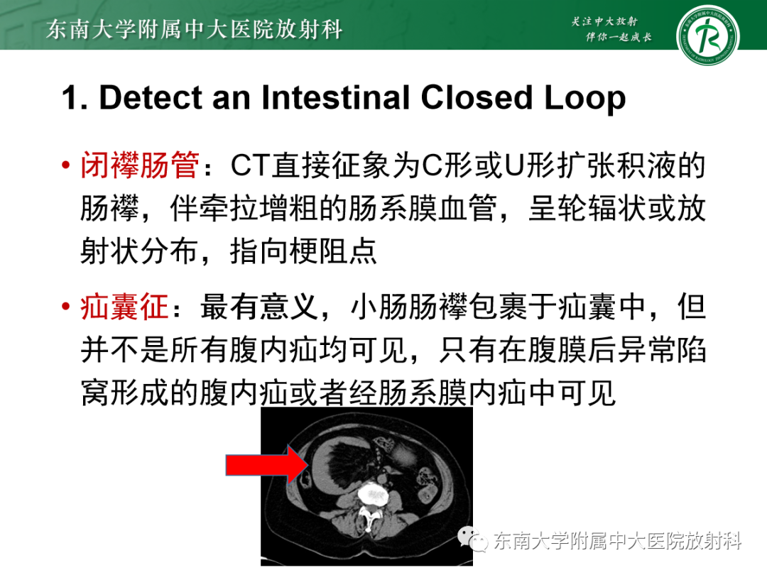 影像PPT - 【PPT】绞窄性小肠梗阻不可忽视的病因——腹内疝-8