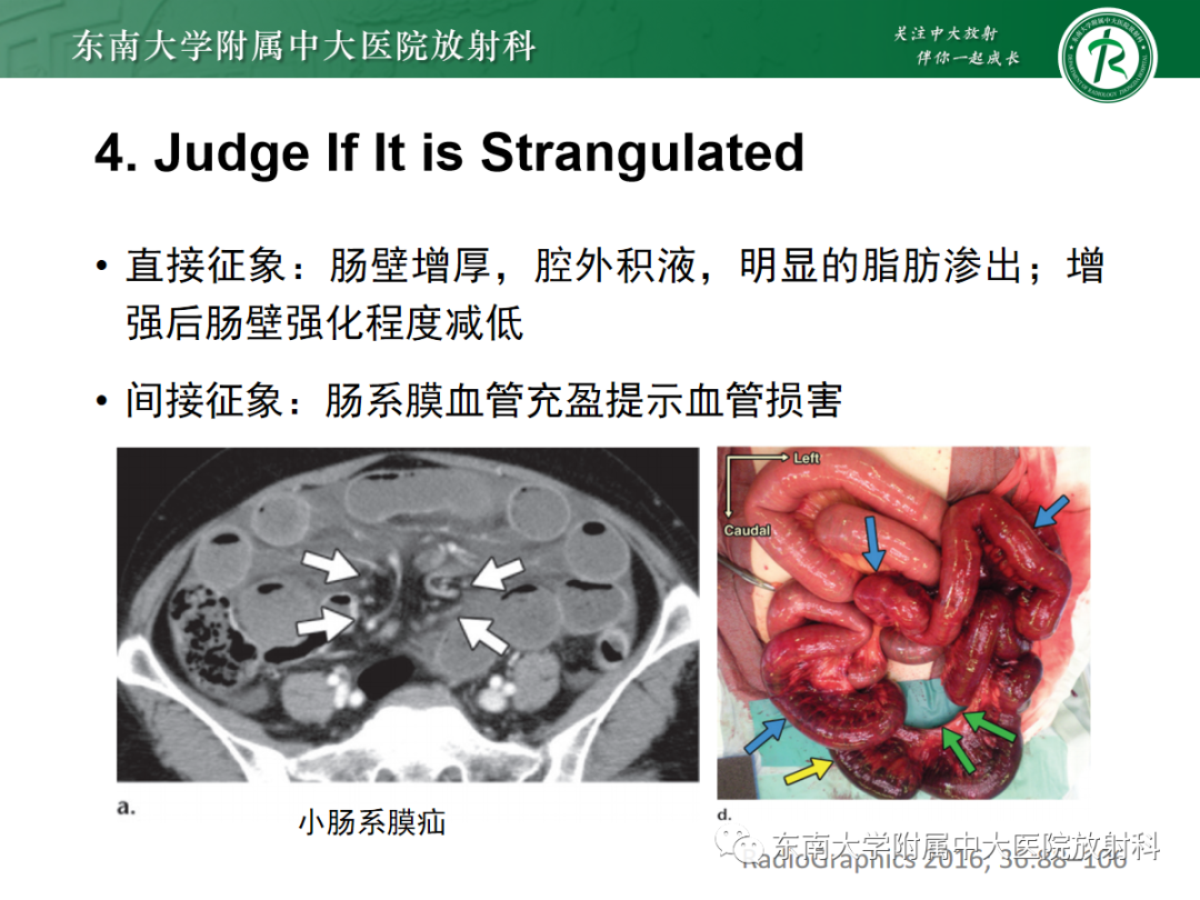 影像PPT - 【PPT】绞窄性小肠梗阻不可忽视的病因——腹内疝-12