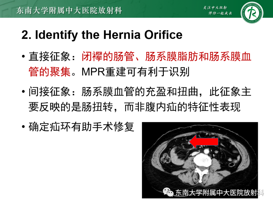 影像PPT - 【PPT】绞窄性小肠梗阻不可忽视的病因——腹内疝-9