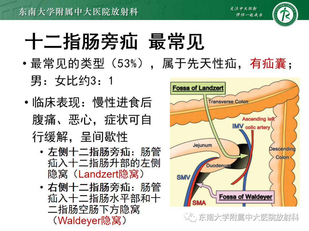 影像PPT - 【PPT】绞窄性小肠梗阻不可忽视的病因——腹内疝-13
