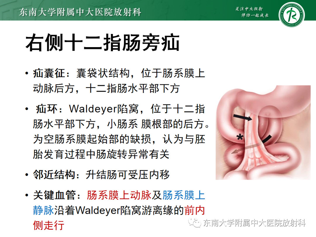 影像PPT - 【PPT】绞窄性小肠梗阻不可忽视的病因——腹内疝-16
