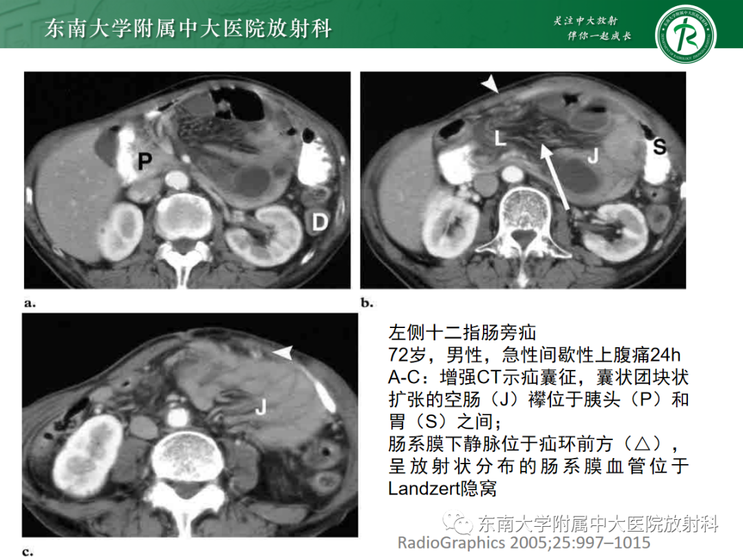 影像PPT - 【PPT】绞窄性小肠梗阻不可忽视的病因——腹内疝-15