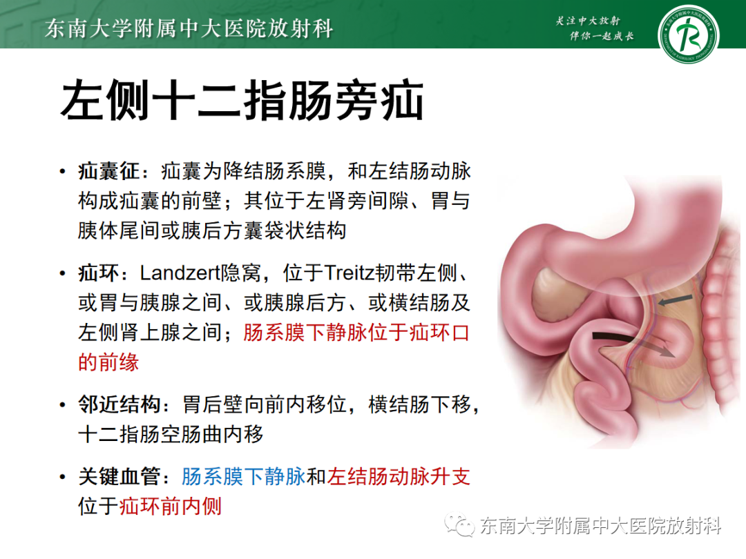 影像PPT - 【PPT】绞窄性小肠梗阻不可忽视的病因——腹内疝-14