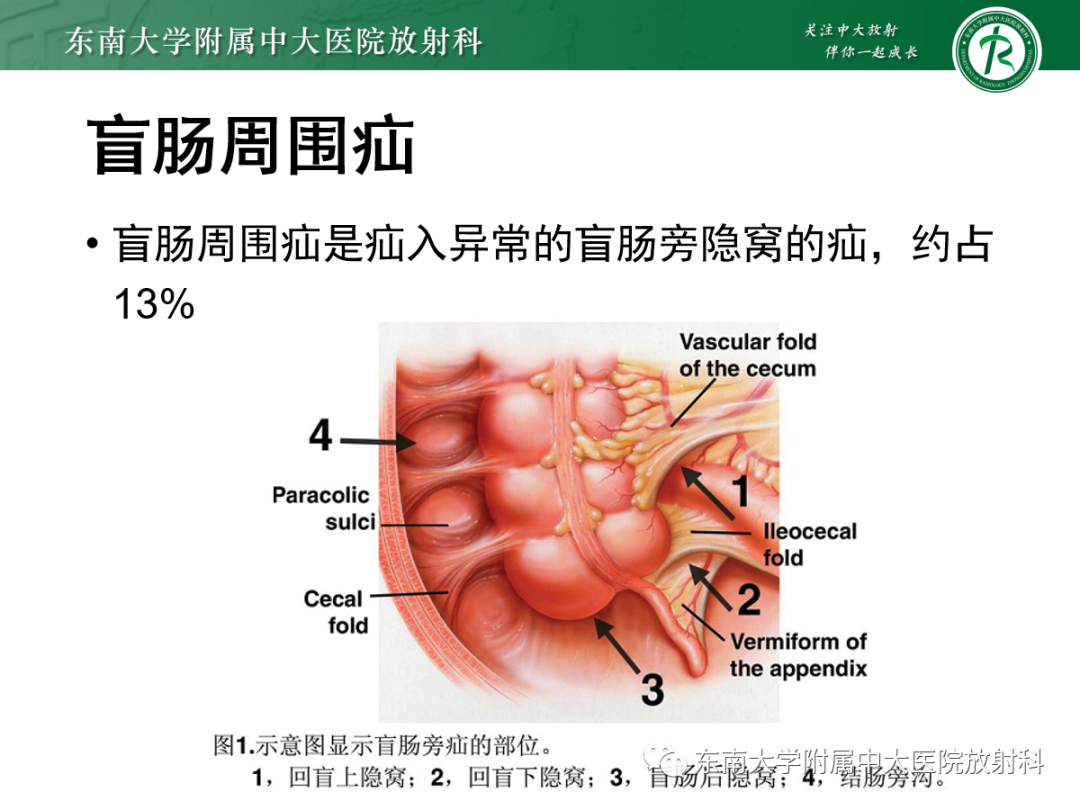 影像PPT - 【PPT】绞窄性小肠梗阻不可忽视的病因——腹内疝-18