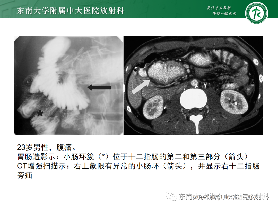 影像PPT - 【PPT】绞窄性小肠梗阻不可忽视的病因——腹内疝-17