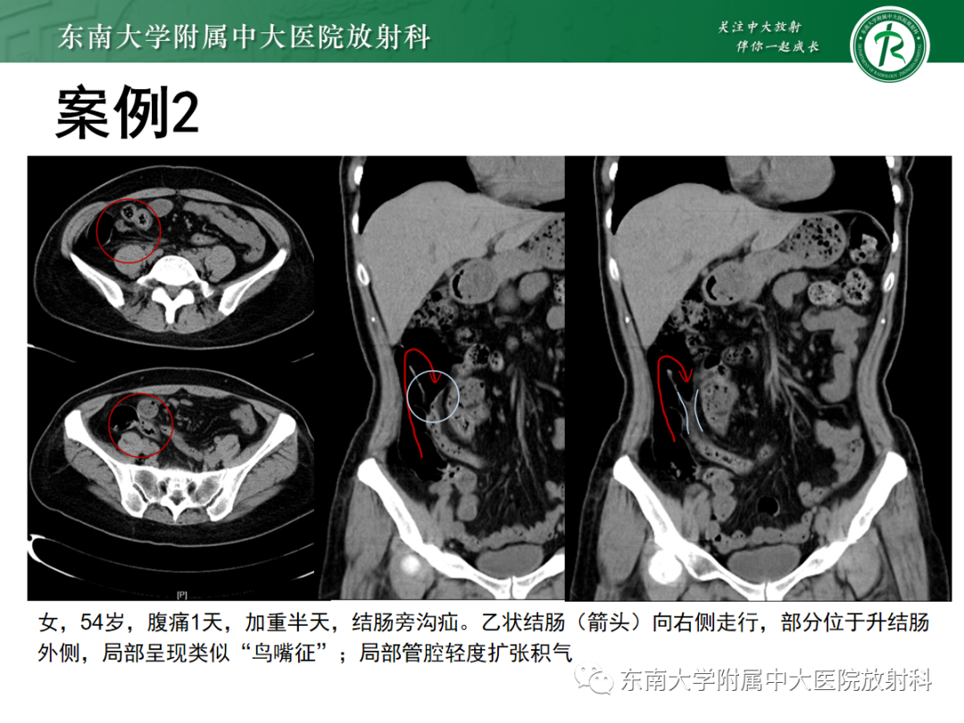 影像PPT - 【PPT】绞窄性小肠梗阻不可忽视的病因——腹内疝-20