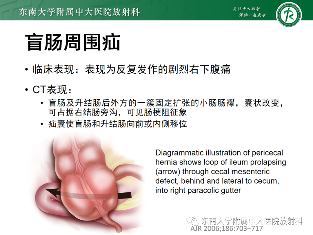 影像PPT - 【PPT】绞窄性小肠梗阻不可忽视的病因——腹内疝-19