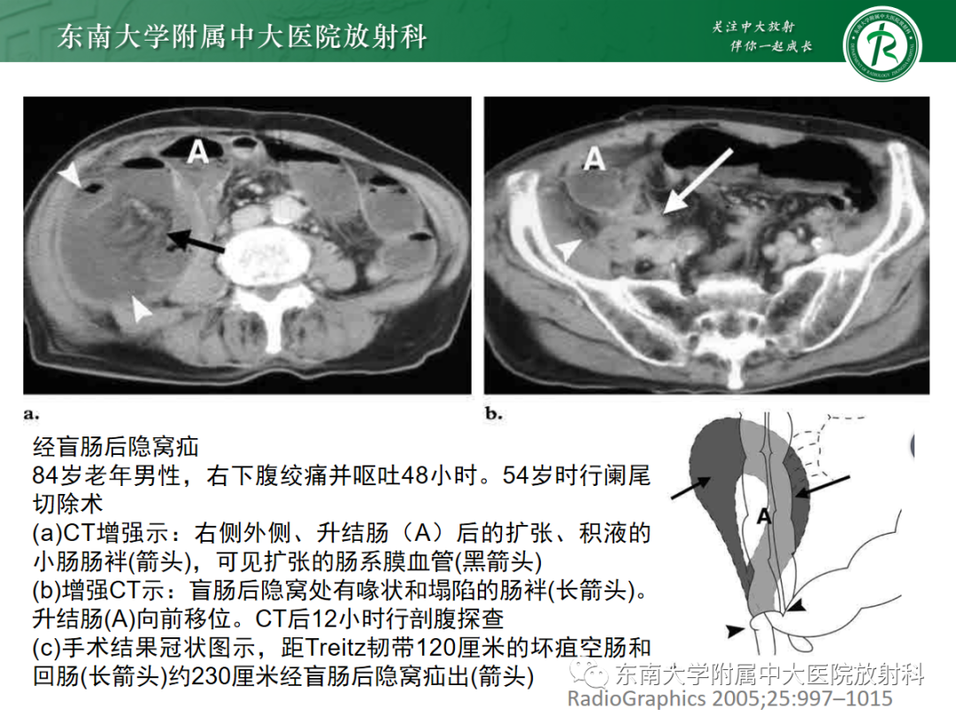 影像PPT - 【PPT】绞窄性小肠梗阻不可忽视的病因——腹内疝-21