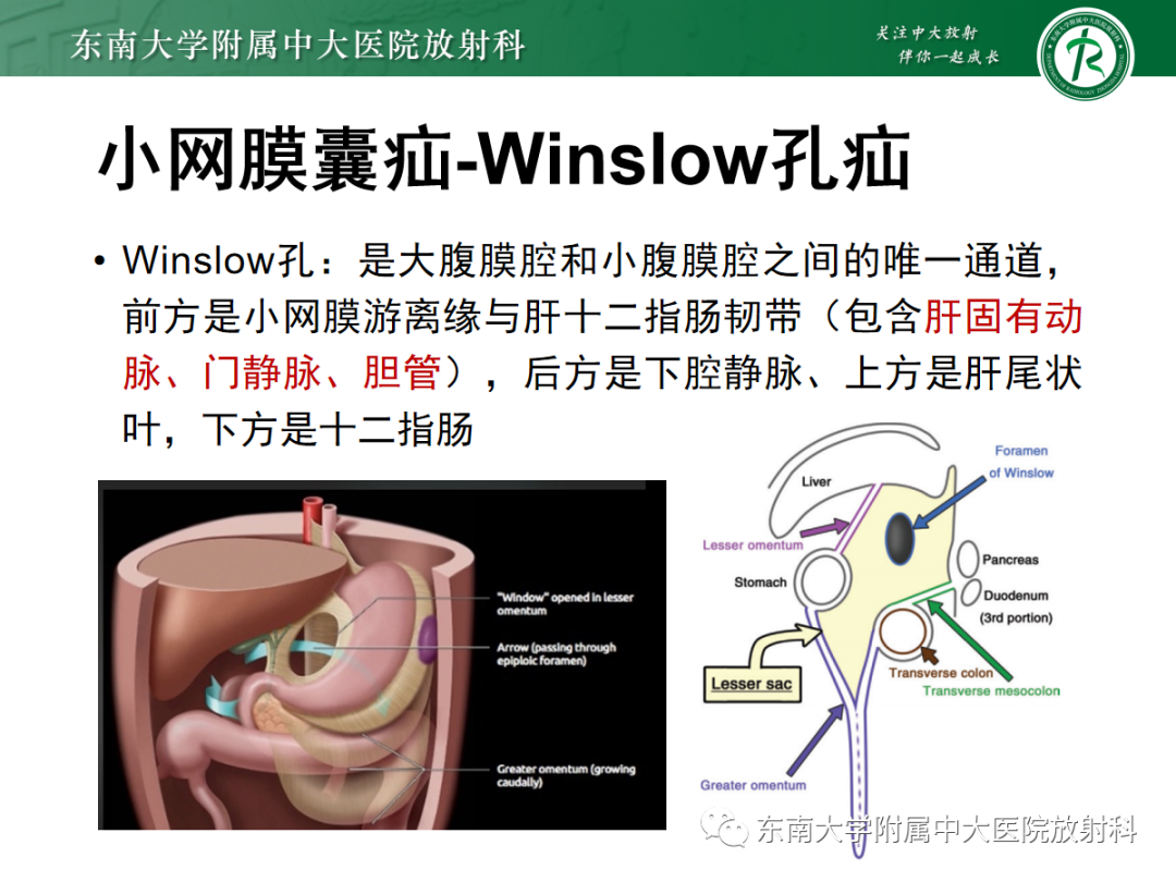 影像PPT - 【PPT】绞窄性小肠梗阻不可忽视的病因——腹内疝-22