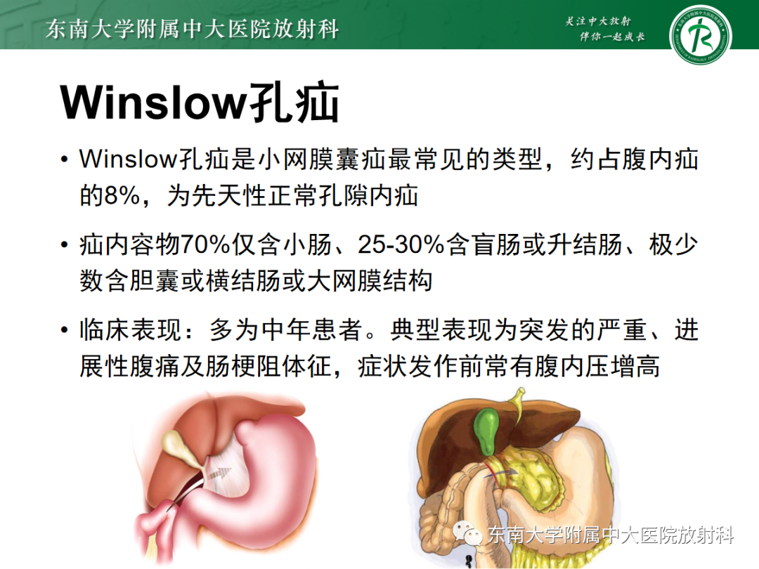 影像PPT - 【PPT】绞窄性小肠梗阻不可忽视的病因——腹内疝-23