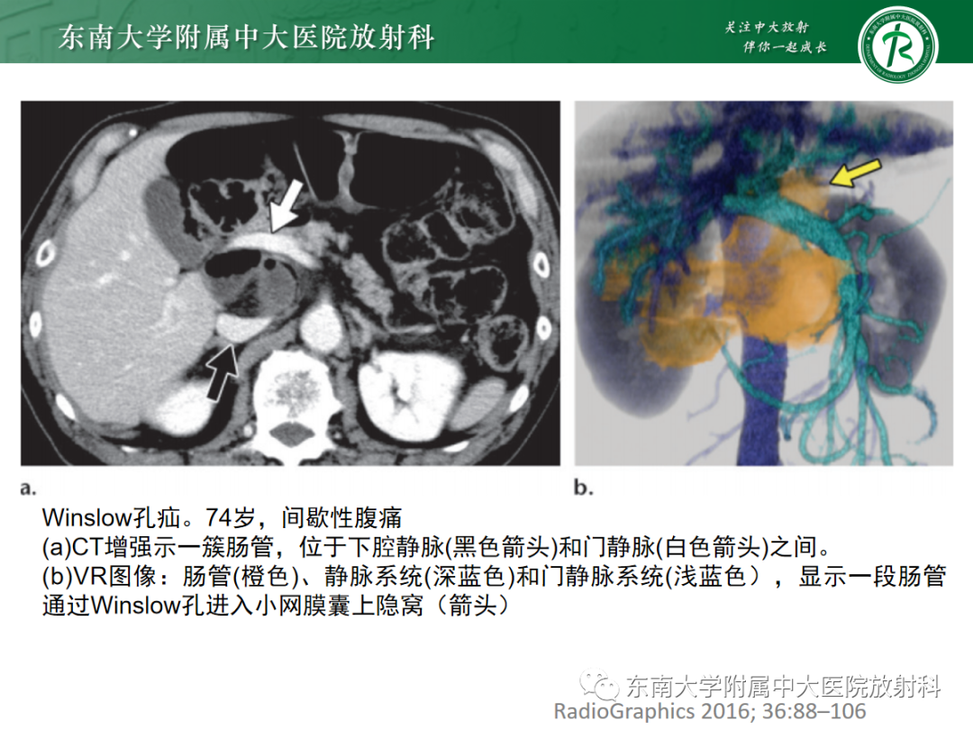 影像PPT - 【PPT】绞窄性小肠梗阻不可忽视的病因——腹内疝-25