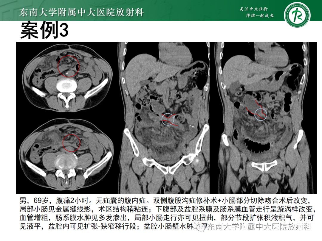 影像PPT - 【PPT】绞窄性小肠梗阻不可忽视的病因——腹内疝-28