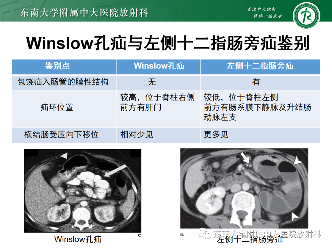 影像PPT - 【PPT】绞窄性小肠梗阻不可忽视的病因——腹内疝-26