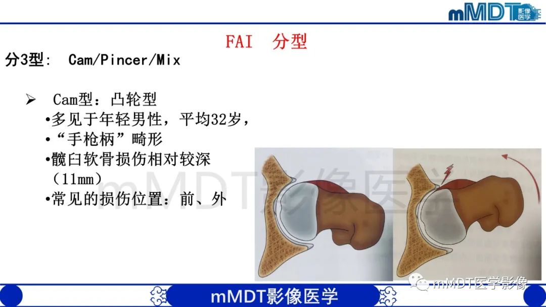 影像PPT - 【PPT】股骨髋臼撞击症影像学改变-8 影像PPT - 【PPT】股骨髋臼撞击症影像学改变-8