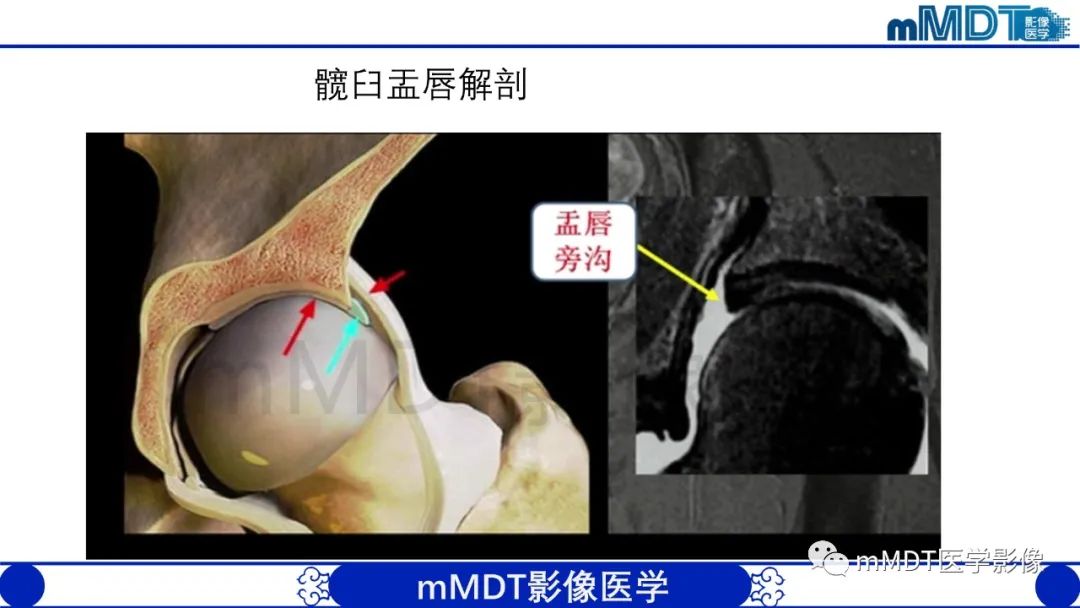影像PPT - 【PPT】股骨髋臼撞击症影像学改变-7 影像PPT - 【PPT】股骨髋臼撞击症影像学改变-7