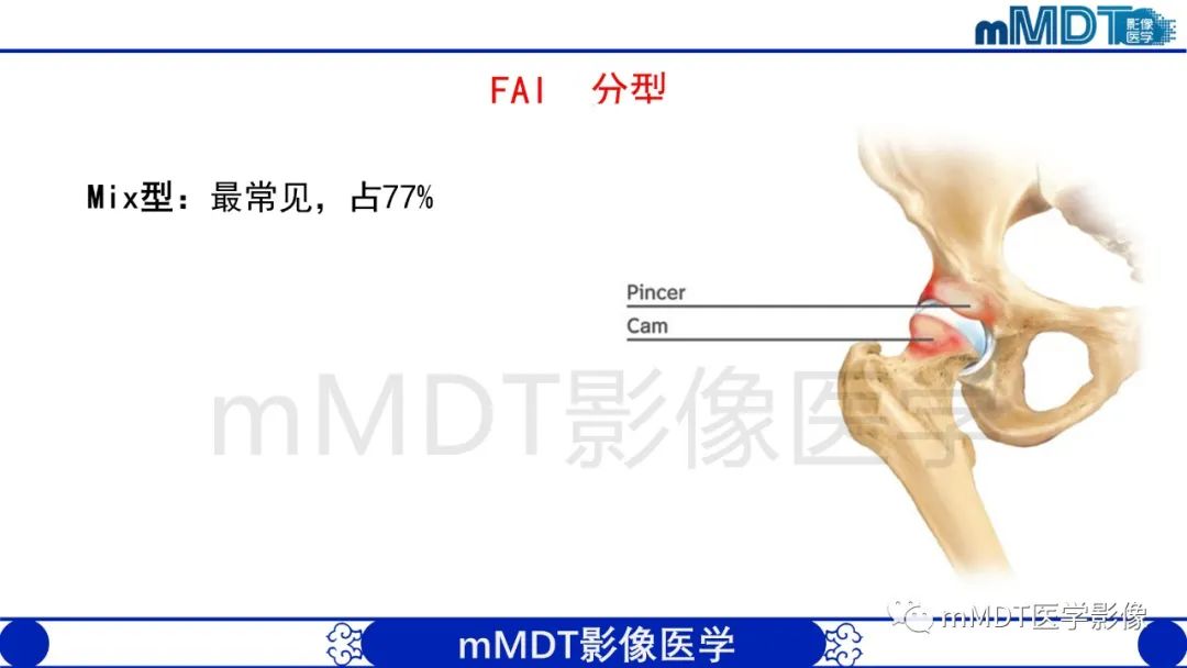 影像PPT - 【PPT】股骨髋臼撞击症影像学改变-10 影像PPT - 【PPT】股骨髋臼撞击症影像学改变-10