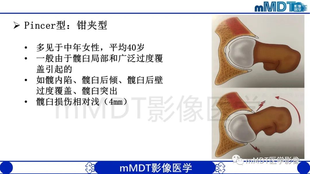 影像PPT - 【PPT】股骨髋臼撞击症影像学改变-9 影像PPT - 【PPT】股骨髋臼撞击症影像学改变-9