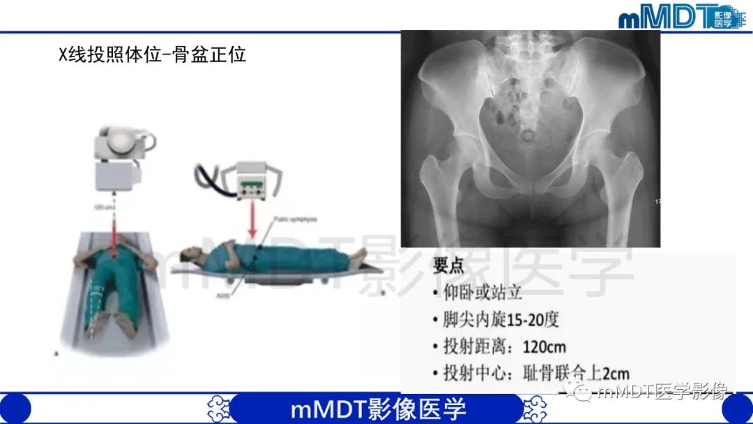 影像PPT - 【PPT】股骨髋臼撞击症影像学改变-12 影像PPT - 【PPT】股骨髋臼撞击症影像学改变-12