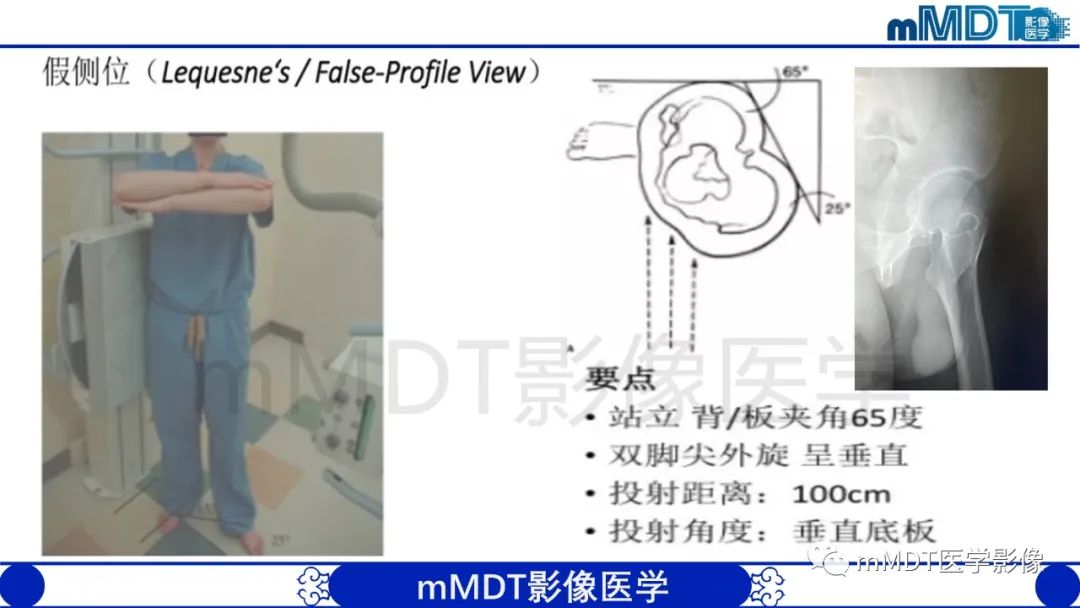影像PPT - 【PPT】股骨髋臼撞击症影像学改变-13 影像PPT - 【PPT】股骨髋臼撞击症影像学改变-13