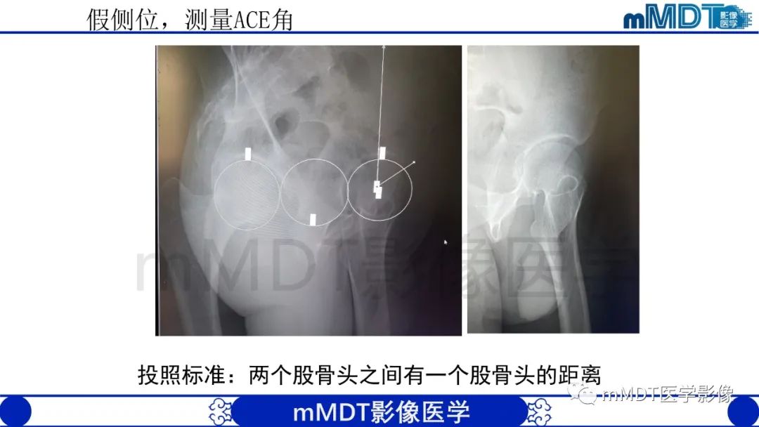 影像PPT - 【PPT】股骨髋臼撞击症影像学改变-14 影像PPT - 【PPT】股骨髋臼撞击症影像学改变-14