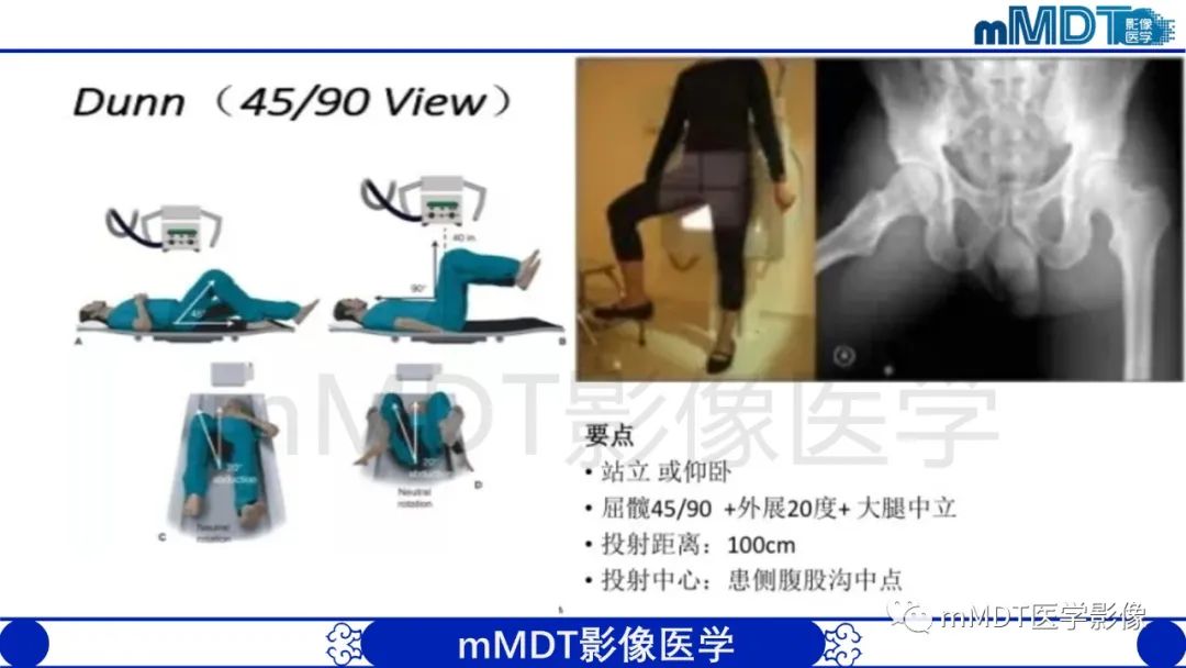 影像PPT - 【PPT】股骨髋臼撞击症影像学改变-15 影像PPT - 【PPT】股骨髋臼撞击症影像学改变-15