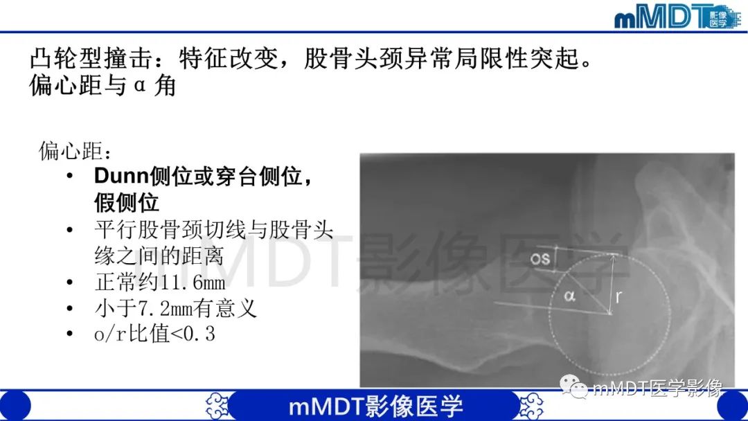 影像PPT - 【PPT】股骨髋臼撞击症影像学改变-16 影像PPT - 【PPT】股骨髋臼撞击症影像学改变-16